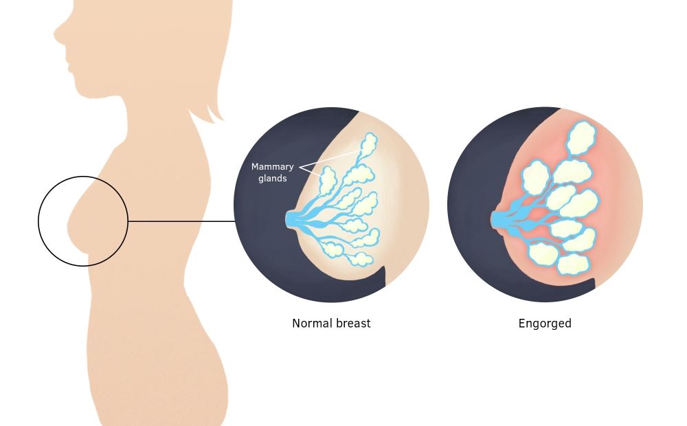 Breastmilk engorgement - Health