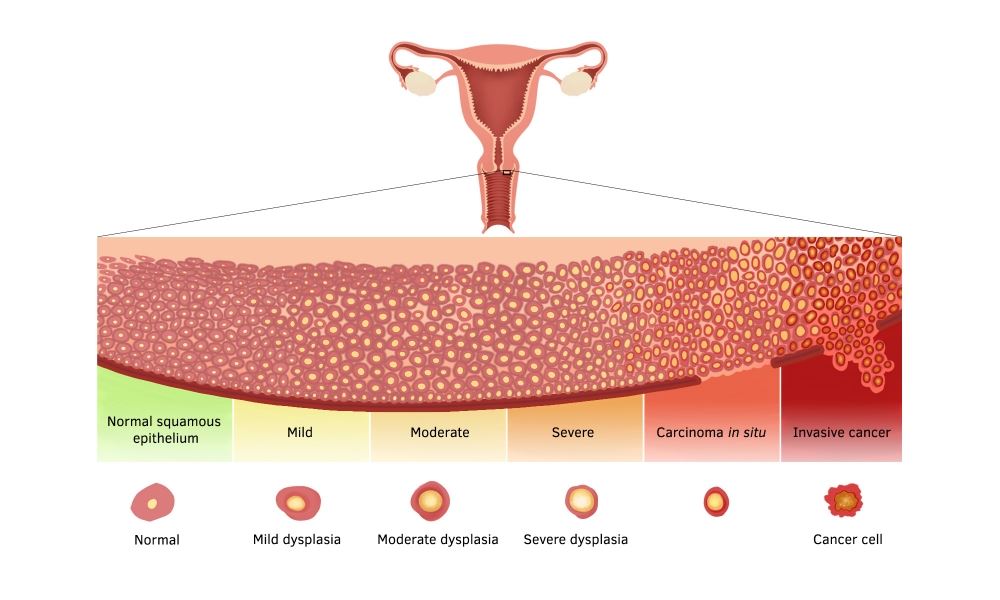 cervical-dysplasia-health